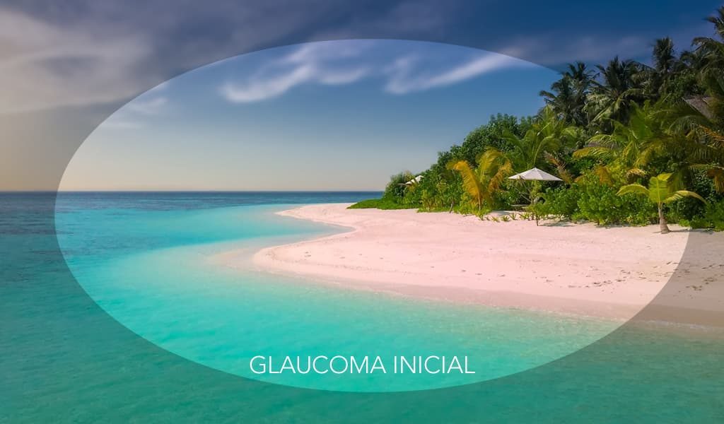 tratamiento del glaucoma